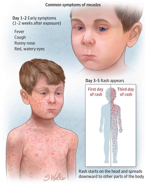 Huddle just included our updates Measles protocol - I can’t believe we reached this point : r ...