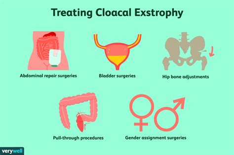 Cloacal Exstrophy: Symptoms, Causes, and Treatment