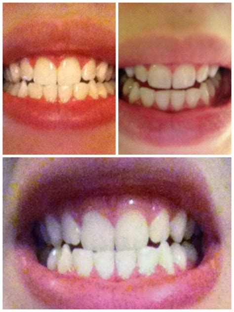 DIY Teeth Whitening: Smile Brilliant Review [Updated 2024] - Inspired Bride