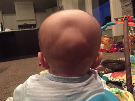 Flat spot/indent on back of head? | BabyCenter