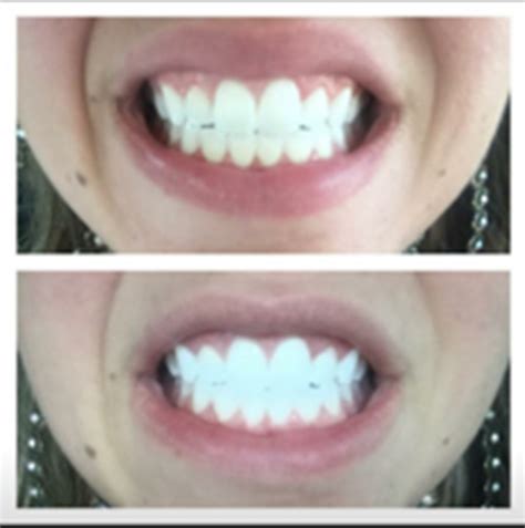 Laser Teeth Whitening - Revivify Medical Spa - Contact Us today