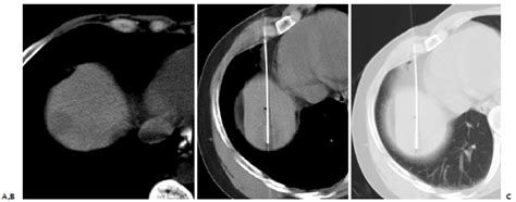 Liver Ablation | Oncohema Key