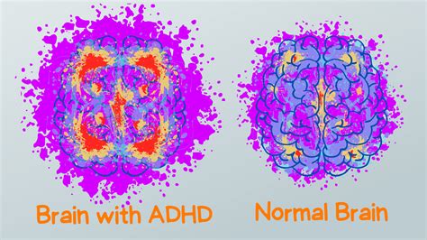 ADHD Brain Differences