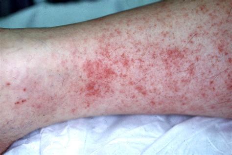 Rocky Mountain Spotted Fever - Dermatology Advisor