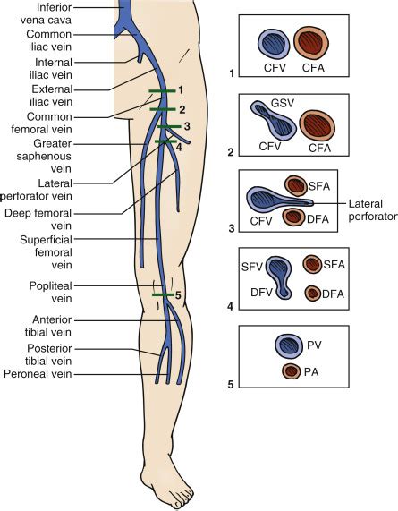 Lower Extremity Deep Venous Thrombosis | Radiology Key