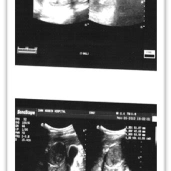 Ultrasound images showed liver hydatid cyst and dilated CBD. | Download Scientific Diagram