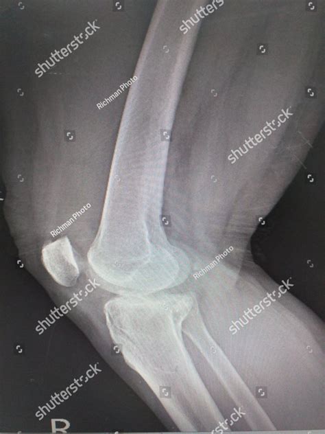 X-ray knee a female 57 year old history fall step Fracture proximal metaphysis of tibia ...