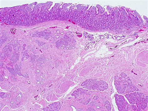 Meckels Diverticulum Histology