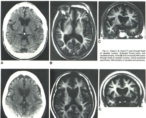 Figure 4 from Magnetic Resonance Imaging in Huntington Disease ...