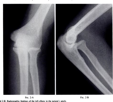 Figure 2 from Familial congenital unilateral anterior dislocation of the radial head ...