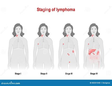 Lymphoma Cartoons, Illustrations & Vector Stock Images - 2752 Pictures to download from ...