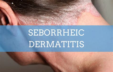 seborrheic dermatitis natural remedies Archives - Best Herbal Health