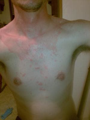 Undiagnosed Non Itchy Body Skin Rash