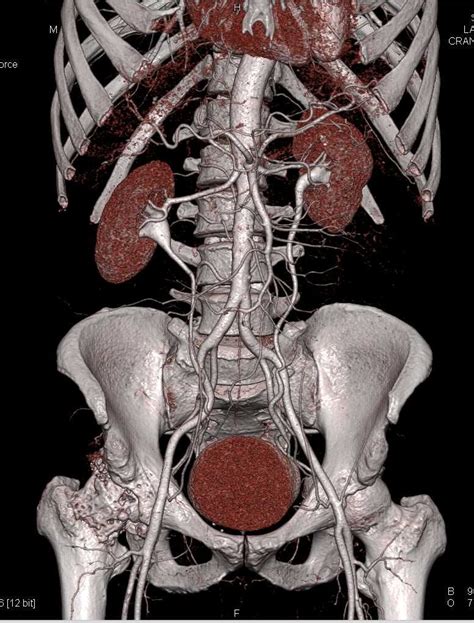 CT Urogram With Mild Medial Positioning of the Ureters / CTisus.com ...