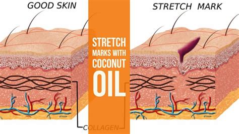 How to Prevent Stretch Marks with Coconut Oil