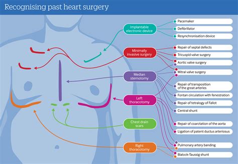 Congenital heart disease in adults | The BMJ