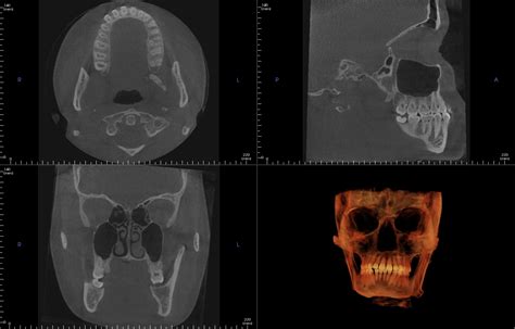 Enamel Pearl CBCT – Dr. G's Toothpix