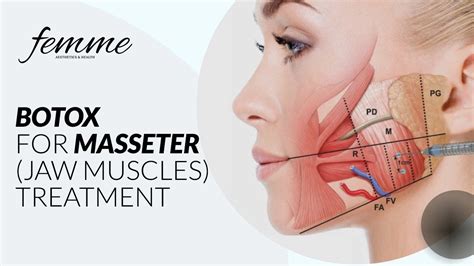 Masseter Botox - Jawline Slimming & Pain Relief Guide