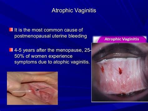 Postmenopausal bleeding for undergraduate