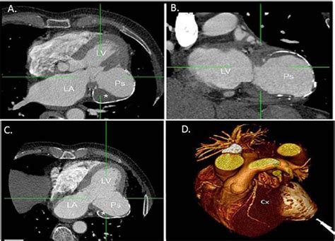 Left ventricular pseudoaneurysm. Contrast cardiac CT demonstrating a... | Download Scientific ...