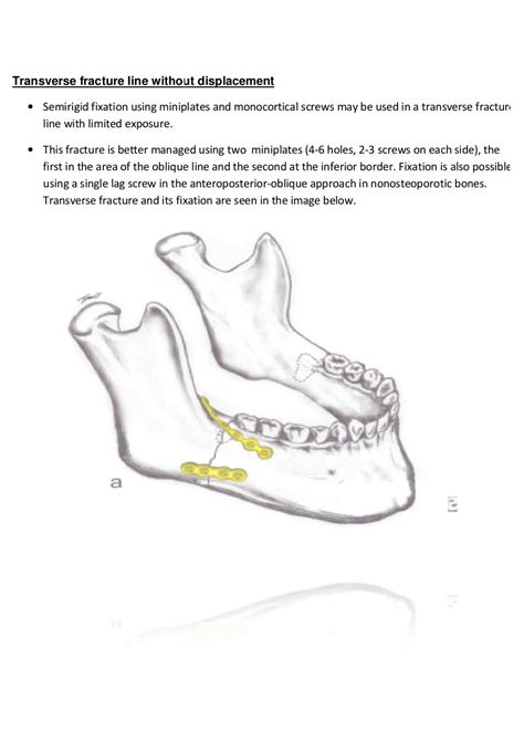 Symphysis & Angle MANDIBULAR FRACTURES