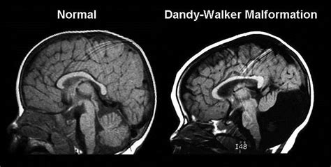 Dandy-Walker Malformation Diagnosis during Pregnancy