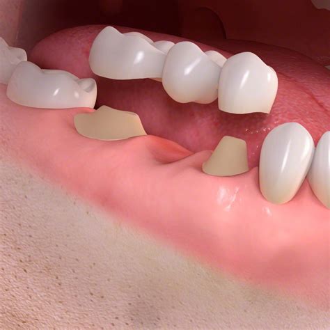 Implants vs. Bridges » New York, NY Dentistry - Dr. Lee & Dr. Dumanian - Delaire Dental