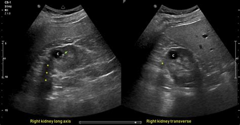 Ultrasound features of Kidney Cysts - Renal Fellow Network