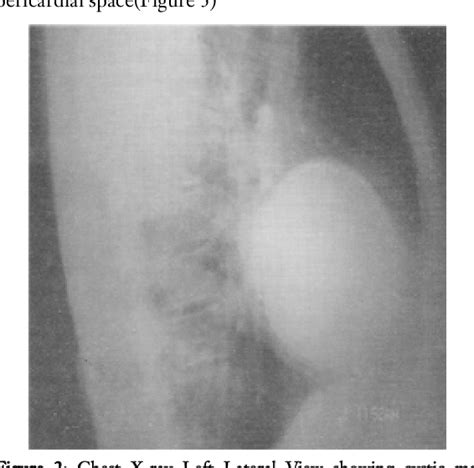 Figure 1 from Giant Pericardial Cyst - Eroding Left Ventricle ...