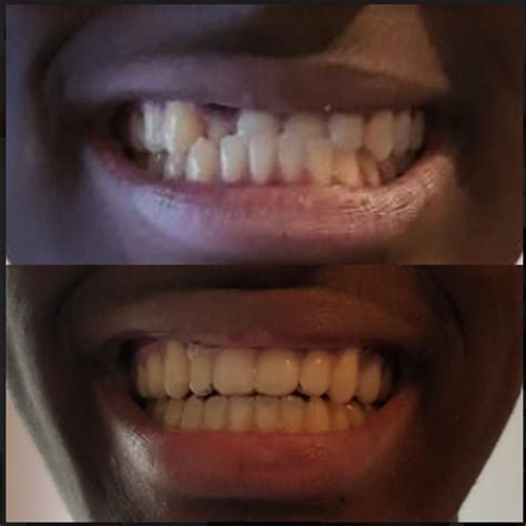 Before and After of teeth straightening | Teeth straightening, Cosmetic braces, Straight teeth