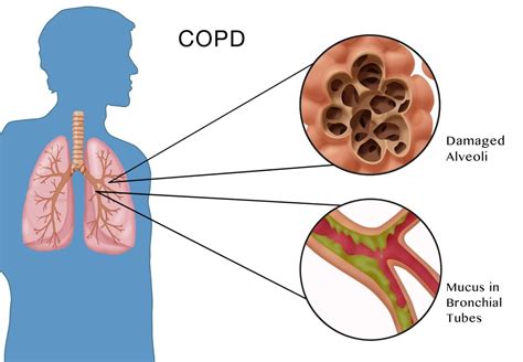 Chronic Obstructive Pulmonary Disease Poster Print by Monica ...