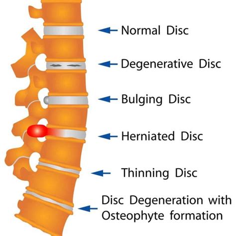 Lumbar Spondylosis - Sun Orthopaedic