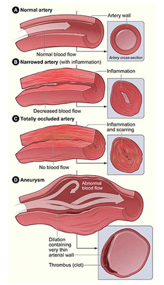 Vasculitis - Wegener's Granulomatosis