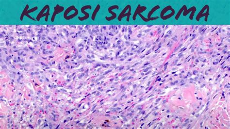 Kaposi sarcoma (vascular tumor pathology histology dermpath dermatology ...