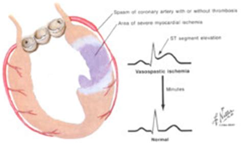 Prinzmetal’s Angina | Cardiac Health