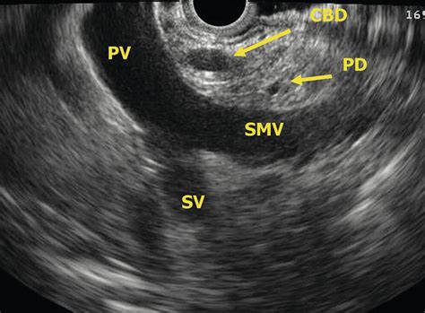 EUS of the Normal Pancreas | Radiology Key