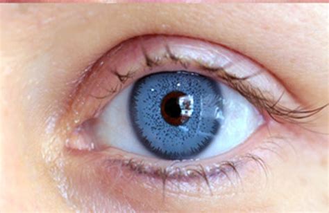 Patient Photos - change eye color without color contacts