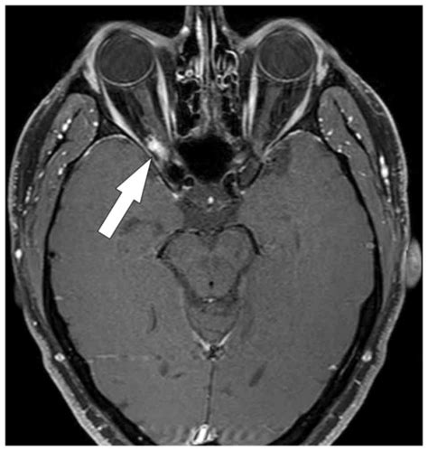 Optic nerve sheath meningioma-findings in the contralateral optic nerve ...