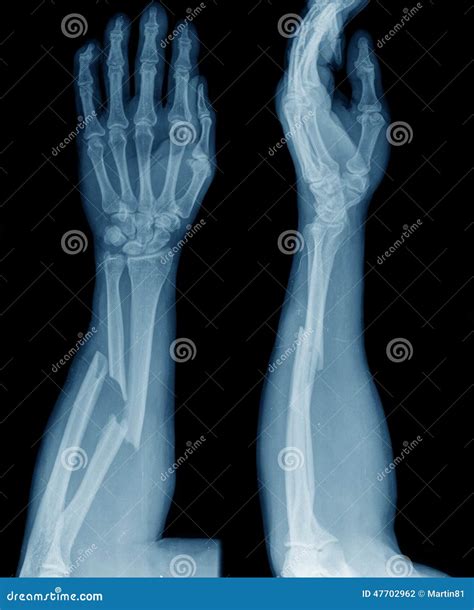 X-ray of broken arm stock photo. Image of carpal, doctor - 47702962