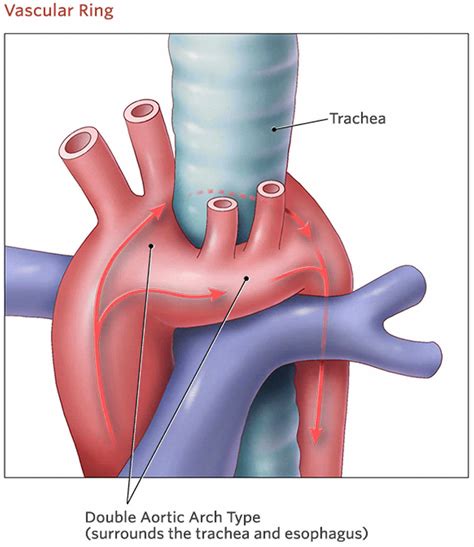 Double aortic arch causes, symptoms, diagnosis, treatment & prognosis