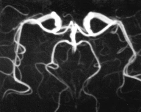 Optic tracts and occipital cortex are observed as normal on the FLAIR ...