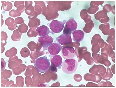 Secondary lymphoblastic leukemia occurring 38 months after the primary diagnosis of multiple ...