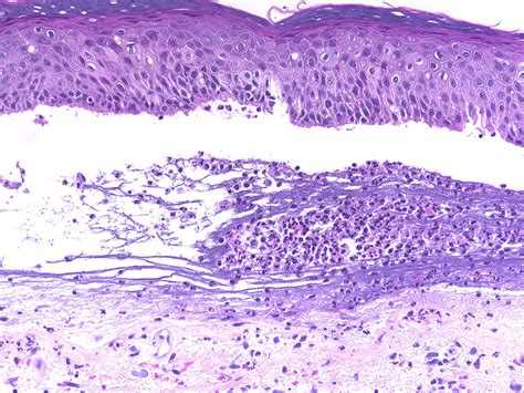 Junctional Epidermolysis Bullosa Histology