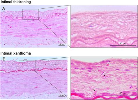 Frontiers | Histological Characteristics of Intracranial Atherosclerosis in a Chinese Population ...