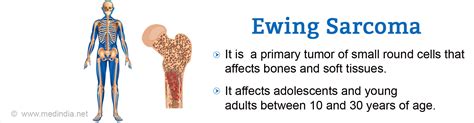 Ewing Sarcoma - Causes, Symptoms, Diagnosis, Prognosis & Treatment