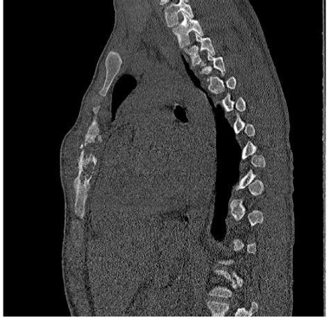 Computed tomography scan showing an osteomyelitis of the sternal body... | Download Scientific ...