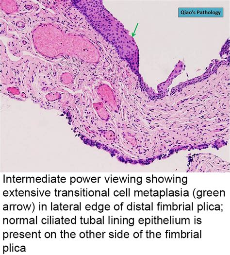 Pathology Outlines - Metaplastic changes