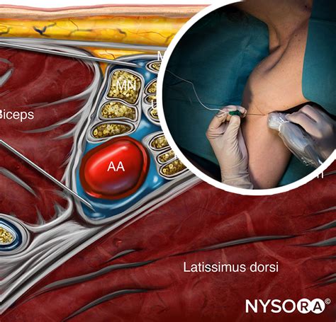 Ultrasound-Guided Axillary Brachial Plexus Block - NYSORA