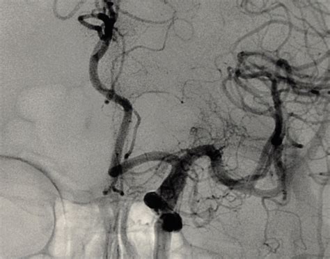 Cerebral angiography