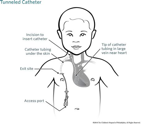 Cuffed Tunneled Dialysis Catheter